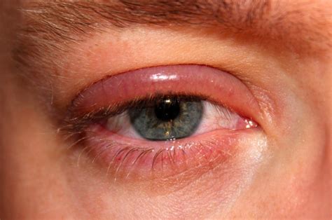 Swollen Eyelid What Is It And How Do I Treat It Eye Health