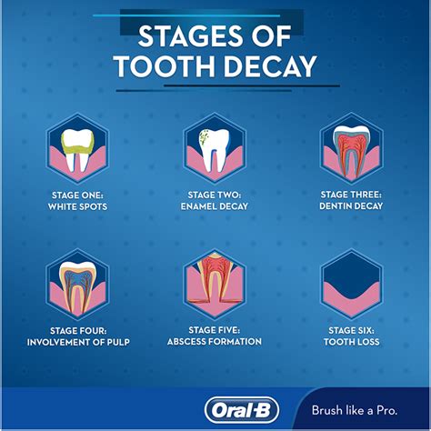 Stages Of Tooth Decay Oral B