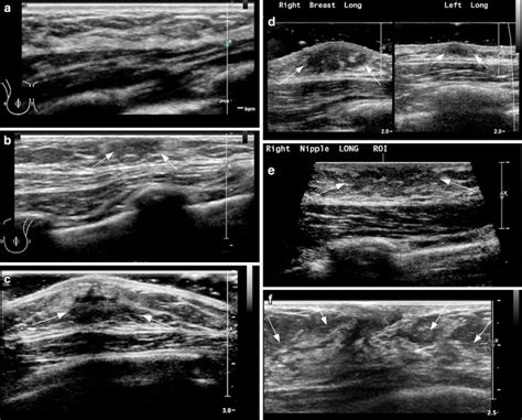 Ultrasound Of Pediatric Breast Masses What To Do With Lumps And Bumps
