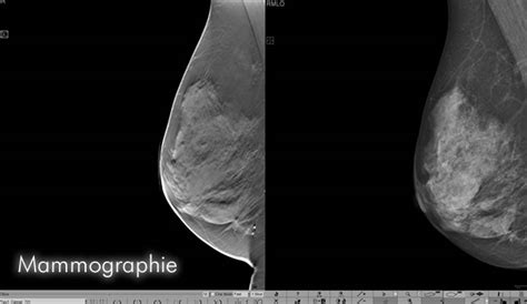 Sie haben vorzugslokalisationen und zwar an den rändern der hirnkammern. Mammographie