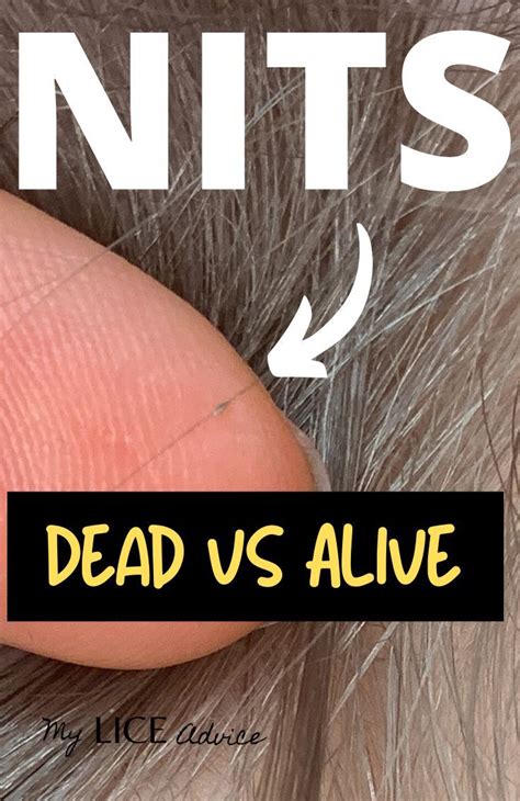 Dead Vs Live Nits Color Of Lice Eggs Lice Eggs Louse Lice Nits