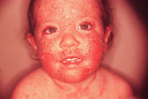 Atopic Dermatitis Medical Pictures Info Health Definitions Photos