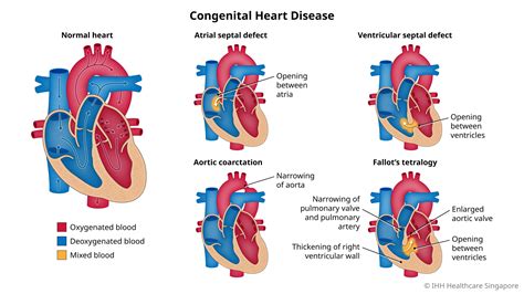 Congenital Heart Disease Chd Symptoms And Causes Parkway East Hospital