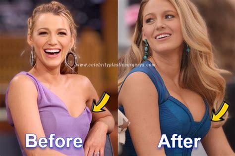 Blake Lively Plastic Surgery Before And After With Pics