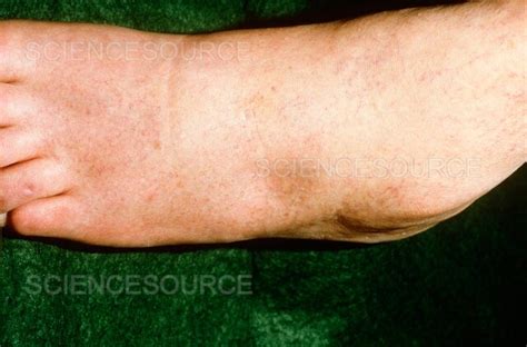 Photograph Pitting Edema Of The Foot Science Source Images