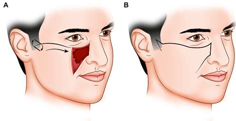 Figure 2 From Reconstruction Of Cheek Defects Secondary To Mohs