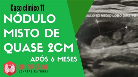 Nódulo Misto Na Tireoide é Grave