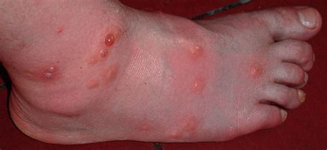 The skeeter syndrome occurs due to an allergy to the polypeptides in the mosquito's saliva. Mosquito Bite Allergenic Reaction