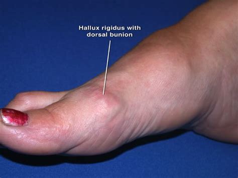 Bone Spur On Top Of Foot Hallux Rigidus In Seattle Hallux Bone