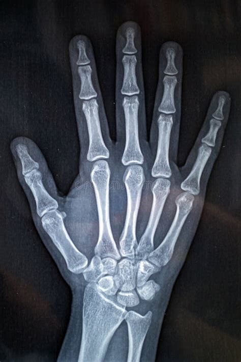 Hand Skeleton With X Ray Stock Photo Image Of Cure 247470790