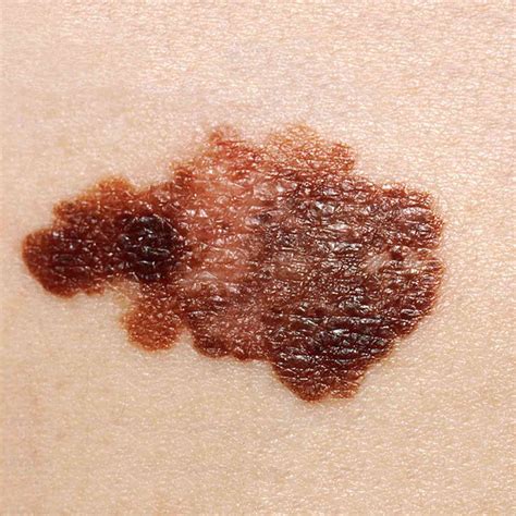 Spot The Differences Between A Mole And Skin Cancer