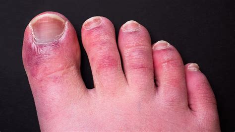 Covid Toes Could Last For 150 Days New Research Finds Nbc Boston