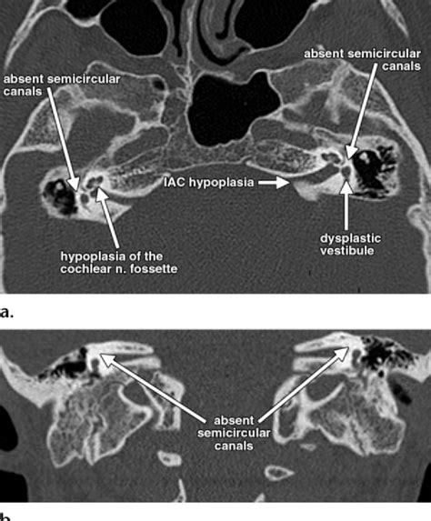 Temporal Bone Ct Anatomy Anatomical Charts And Posters