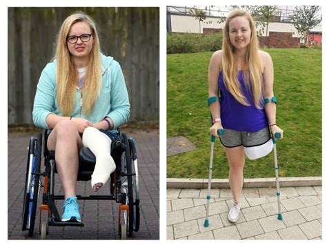 Scots Swimmer Has Leg Amputated After Raising £10000 Through