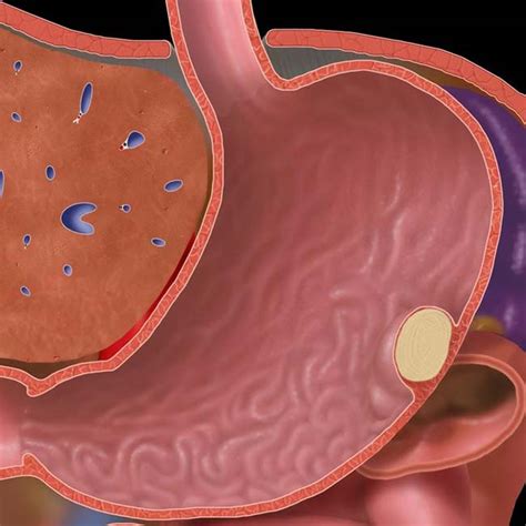 Intramural Benign Gastric Tumors Radiology Key