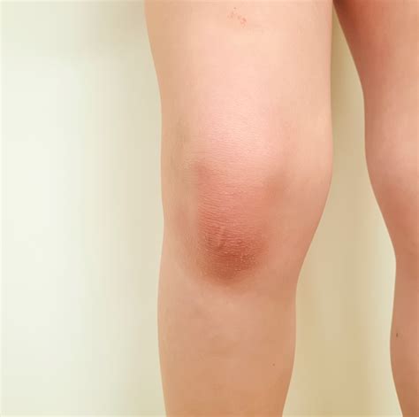 The Real Reason Your Knee Is Swollen According To Doctors Swollen
