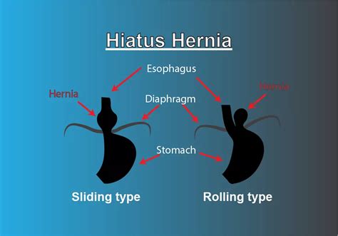 What Is Hiatus Hernia Causes Symptoms Complications Diagnosis