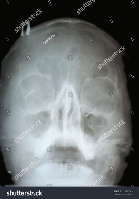 Broken Nose Xray Stock Photo 129995045 Shutterstock