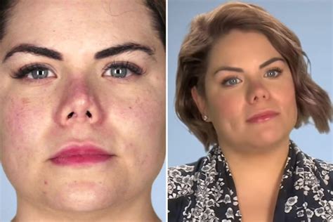 Simulate nose jobs (rhinoplasty), neck lifts, chin augmentation, botox, breast augmentation, and more. Woman left with 'pig's nose' after four nose jobs turns to ...