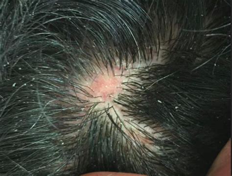Dissecting Cellulitis Early Disease Can Look Like Alopecia Areata