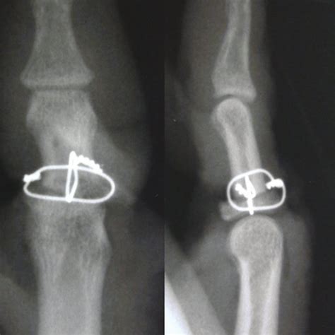 Early Post Operative Antero Posterior And Lateral Radiographs Of Finger
