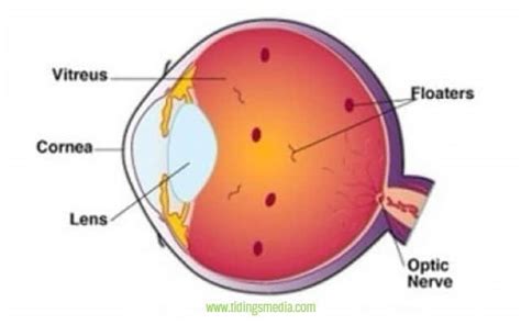 Black Spots In Vision Sudden Not Floaters Pictures Causes Get Rid