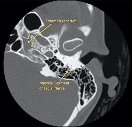 Normal Temporal Bone CT With Annotated Images Radiology Case