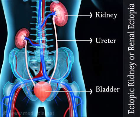 Pelvic Kidney Anatomy Prevention Of Ureteral Injuries In Gynecologic