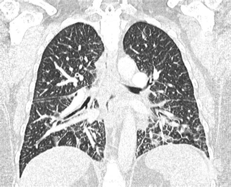 Ct Scan Of The Lung