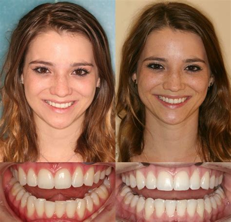 Invisalign Before And After Photos Dr Ginger Price Elite Invisalign
