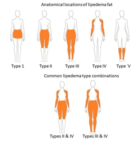 Subcutaneous Adipose Tissue Diseases Dercum Disease Lipedema