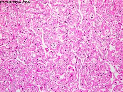 Pathology Outlines Chromophobe Type Renal Cell Carcinoma