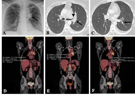 Cureus A Case Of Acute Heart Failure Following Immunotherapy For