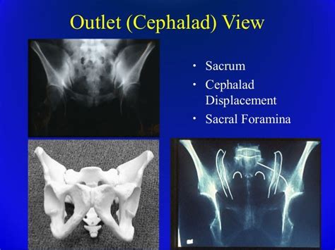 Trauma Pelvic Fracture Ortho Prespective