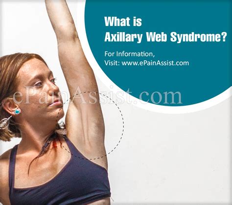 What Is Axillary Web Syndrome Causes Symptoms Treatment
