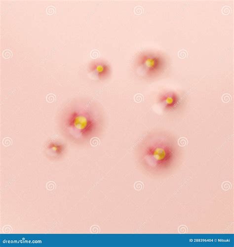 Acne Pustule Inflammation Top View Stock Illustration Illustration Of