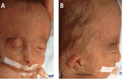 Association Of Goldenhar Syndrome With Trisomy