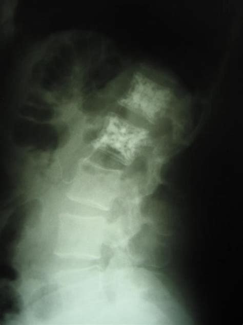 Leczenie chirurgiczne naczyniaków kręgosłupa | Zapytaj lekarza