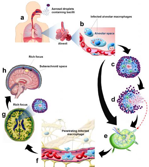 Pathogenesis Of Tb Flowchart