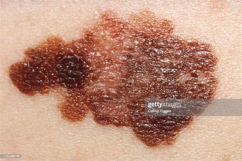 Melanoma Skin Cancer High Res Stock Photo Getty Images