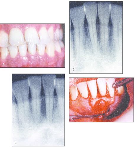 Lateral Periodontal Cyst A Clinical Photograph Showing Mild Gingivitis