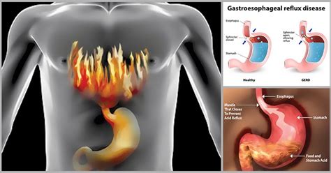 Reasons Why We Shouldnt Ignore Heartburn Dr Farrah Md