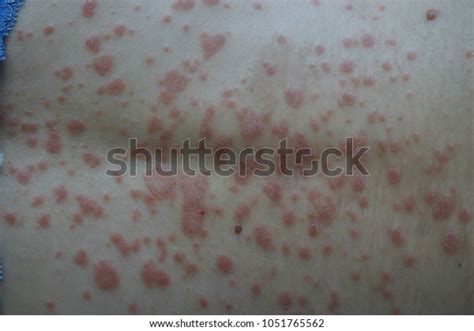 Guttate Psoriasis On Back Stock Photo Edit Now 1051765562