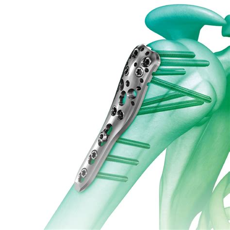 Philos Plate An Advanced Solution For Proximal Humerus Fractures