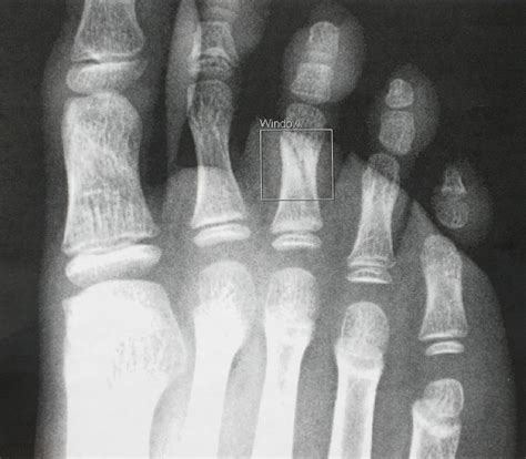 4th toe fracture4th toe fracture xraymedical studentsmedical casesradiology#fracture#xray#medicalcases. Fractured Little Toe - Fracture Treatment