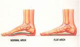 Pictures of Flat Feet