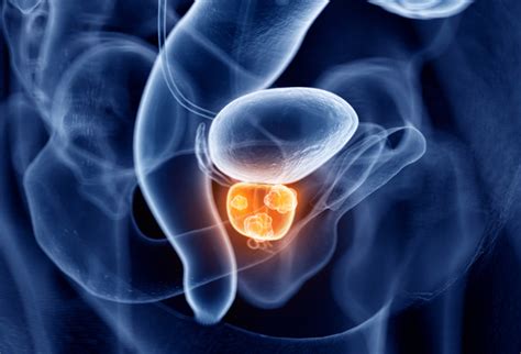 Cancer Agressif De La Prostate Cancer De La Prostate Symptomes Diagnostic Et Traitement