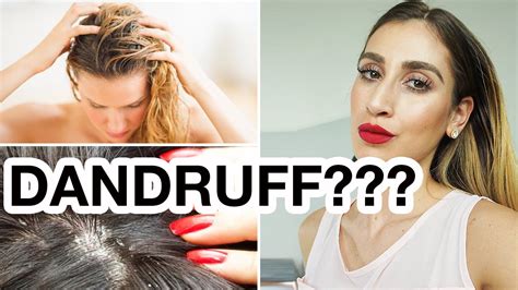 If you've ever suffered from dandruff, you know just what an embarrassing, itchy, and annoying problem it can be. 16 MIND-BLOWING Dandruff and Dry Itchy Scalp Treatments ...