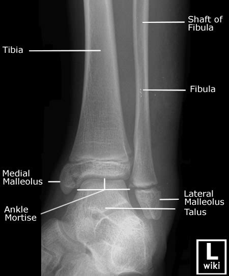 Ankle X Rays