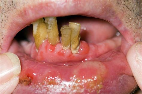 They are also known as canker sores. Mouth Ulcers From Myelodysplasia Photograph by Dr P ...